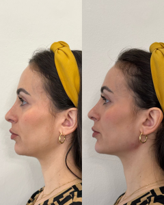 Armonización Facial