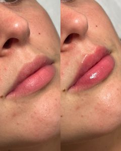 HIDRATACIÓN - AUMENTO DE LABIOS