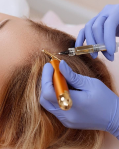 Mesoterapia Capilar