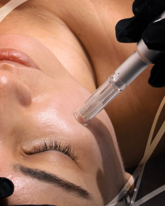 Microneedling