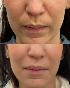 Relleno surco Nasogeniano